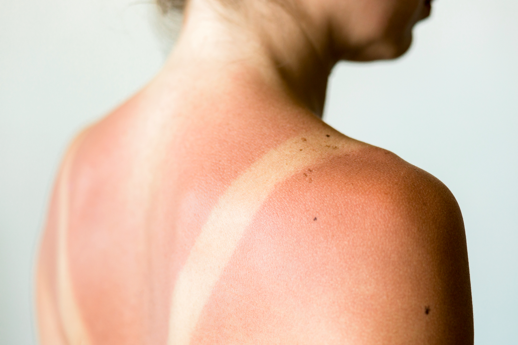how-to-treat-sunburn