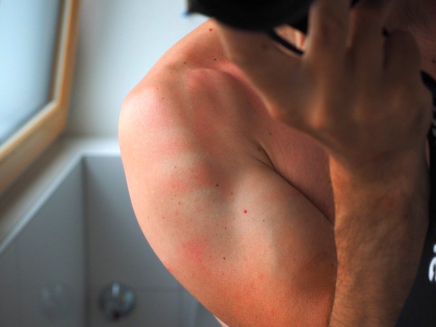 How to Treat a Sun Burn (20 Fast & Easy Hacks) 1 sunburn