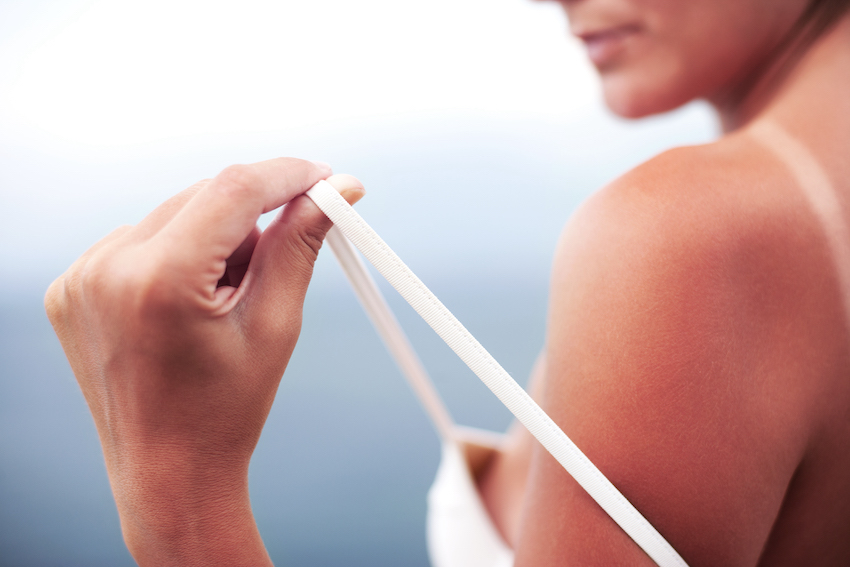 Why Does My Sunburn Itch? 1 sunburned skin