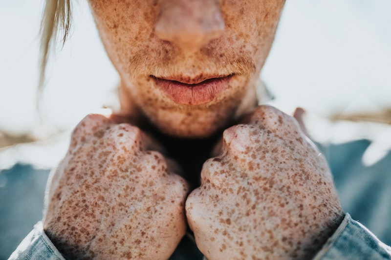 freckle skin